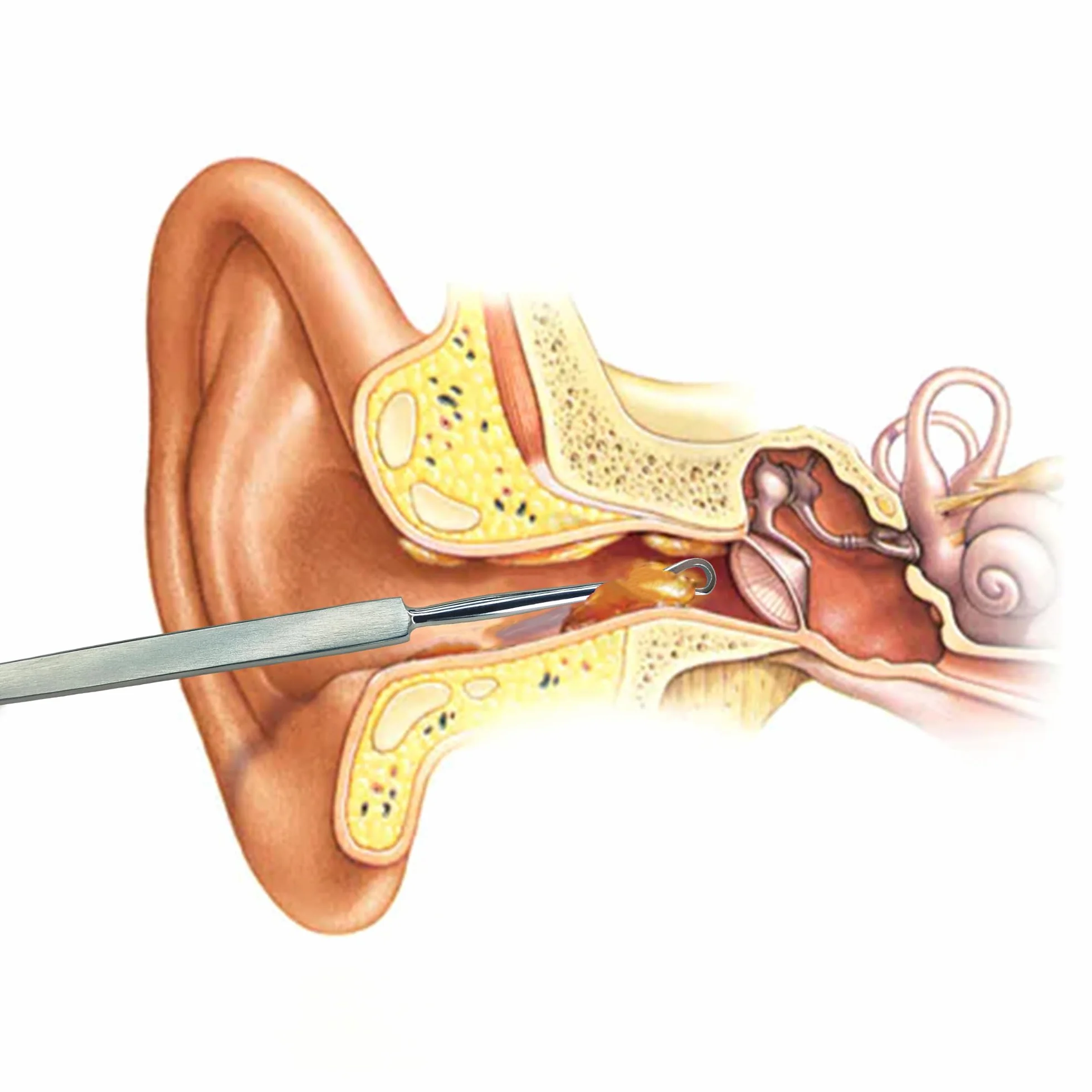 MJW Professionale Rimuovi cerume Di acciaio inossidabile- Strumento Curette Orecchie A Rimuovere l'irrigazione Dell'orecchio, Detergente per Orecchie Igienico Riutilizzabile per Adulti e Bambini