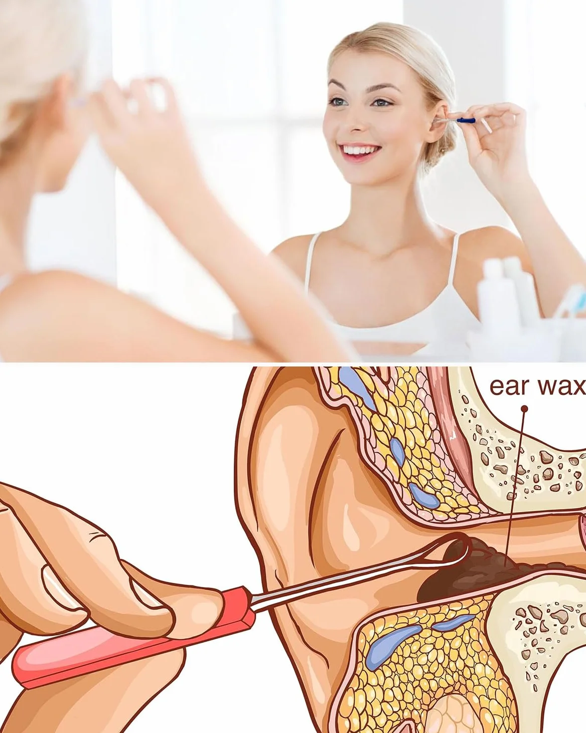 5Pcs Professionale Rimuovi cerume Di acciaio inossidabile- Strumento Curette Orecchie A Rimuovere l'irrigazione Dell'orecchio, Detergente per Orecchie Igienico Riutilizzabile per Adulti