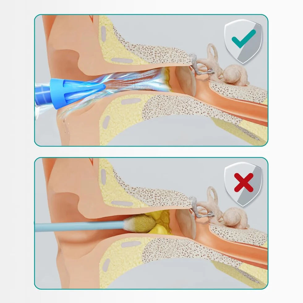 Medi Grade Kit Siringa Pulisci Orecchie – Siringa per Tappi Orecchie con 3 Punte a Getto Quadruplo –Kit per Pulizia Orecchie di Uso Domestico - Migliora la Chiarezza L’udito