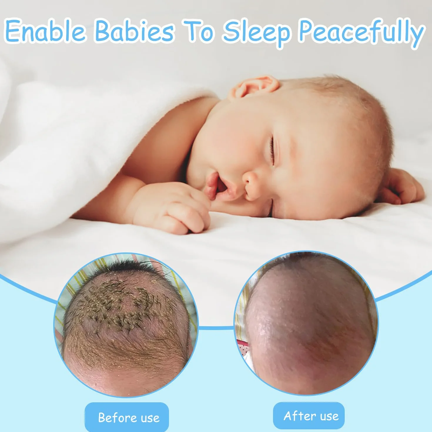 2 Pezzi Spazzola da Bagno per Neonati, Spazzola per Bambini in Silicone, Pettine Neonato per Rimuovere La Crosta Lattea Del Bambino（Balenottera Azzurra）