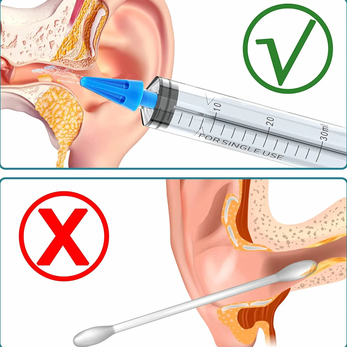 Pulitore Orecchie con 4 Punte a Getto Quintupla, Kit Siringa Pulisci Orecchie, Pulitore Intelligente per le Orecchie per Rimuovere il Cerume Facile da pulire per Bambini e Adulti