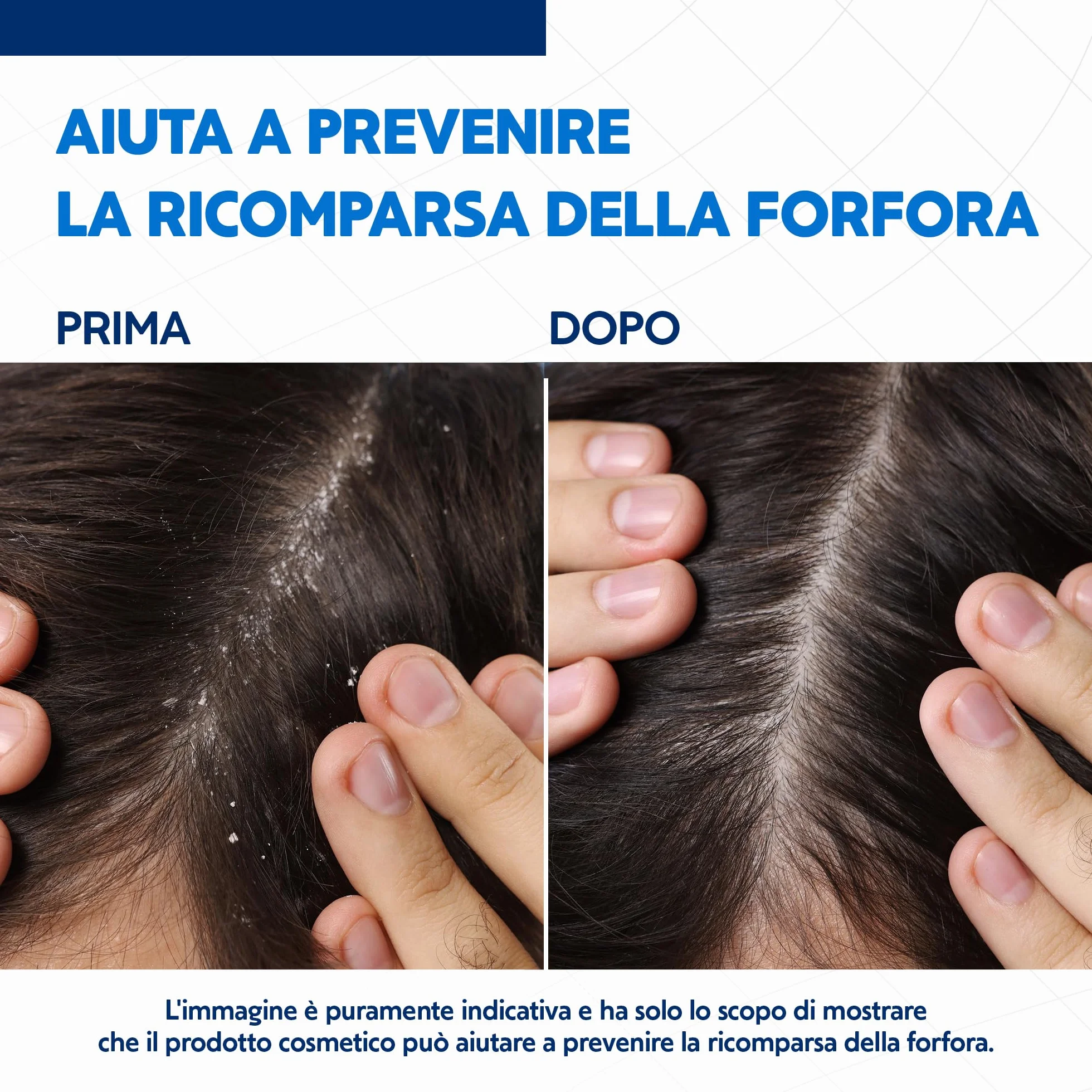 EG Nizoral Care Shampoo Cute e Capelli Grassi | Protezione Continua da Forfora e Prurito | Azione 3 in 1 Clinicamente Testata| 200 ml